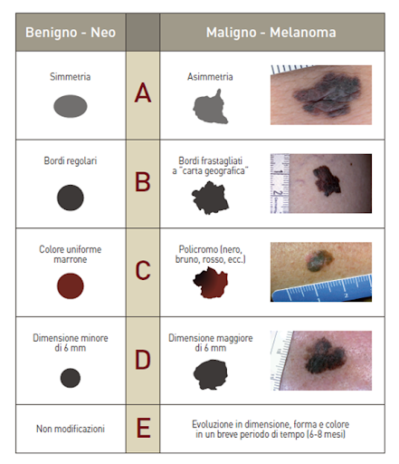 Pericolo melanoma - Regola ABCDE