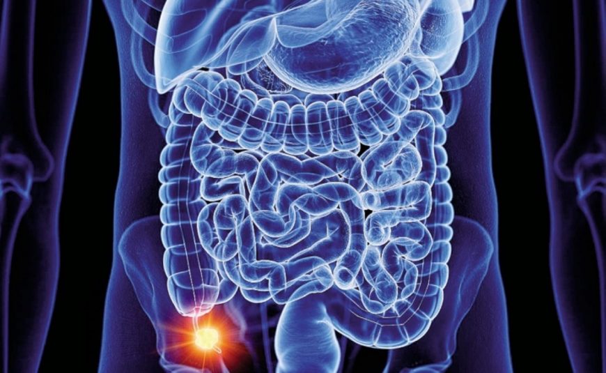 Per appendicite è meglio operare in laparoscopia